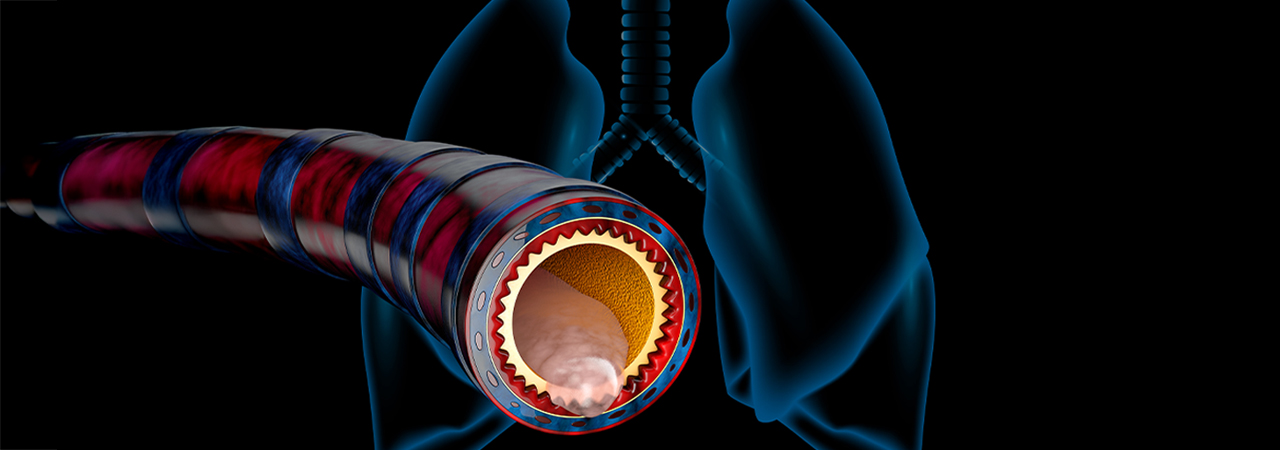Pneumologie, BPCO, prise en charge, mucus